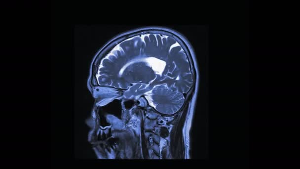 Imágenes Resonancia Magnética Del Cerebro Aislado Negro — Vídeos de Stock