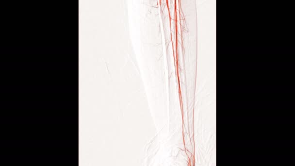 在黑色上分离的腿血管造影录像 — 图库视频影像