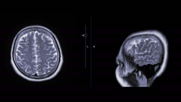 Beeldmateriaal Van Mri Van Hersenen Geïsoleerd Zwart — Stockvideo