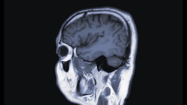 黑脑分离的Mri片段 — 图库视频影像