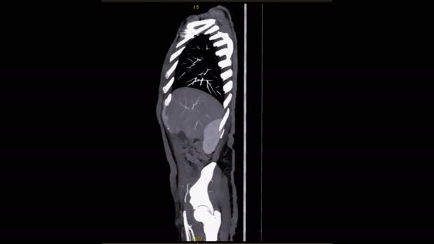 séquence de CTA de l'aorte isolée sur noir 