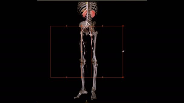 Cta股动脉3D影像在黑色上分离 — 图库视频影像