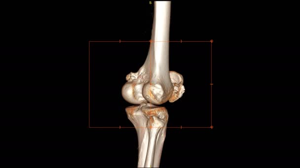 Imágenes Rodilla Cta Renderizado Aislado Negro — Vídeos de Stock