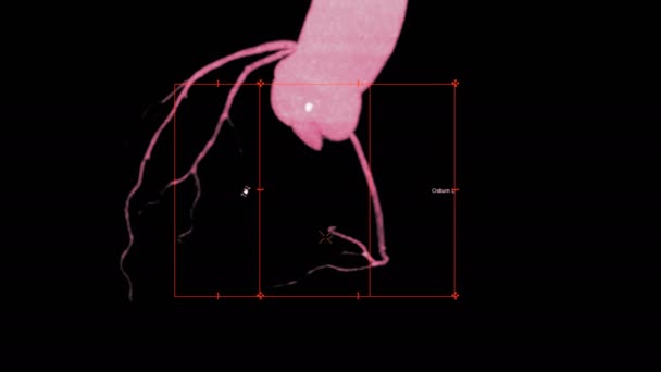 Cta Coronaire Slagader Korte Vlak Het Scherm Voor Diagnose Coronaire — Stockvideo