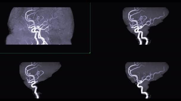 Visão Vertical Eixo Longo Artéria Coronária Cta Para Detectar Doença — Vídeo de Stock