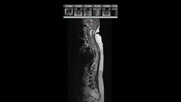 黒で隔絶された背骨全体の映像 — ストック動画
