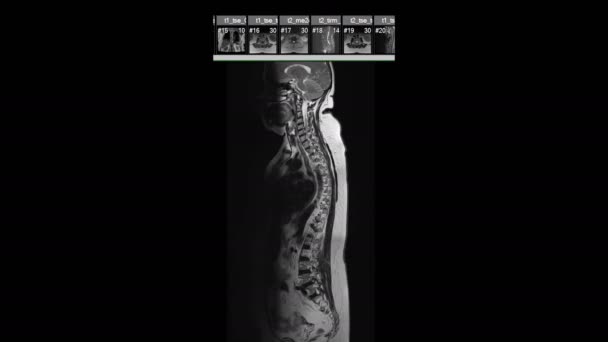 Footage Whole Spine Mri Isolated Black — Stockvideo