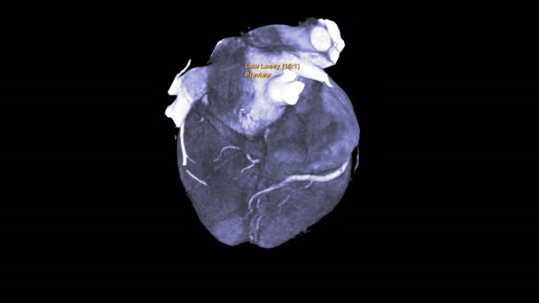 冠動脈狭窄やCadの診断のための画面上のCta冠動脈短い軸平面 — ストック動画