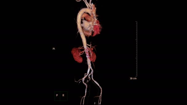 Cta Intera Aorta Immagine Rendering Invertire Sullo Schermo Rilevare Aneurisma — Video Stock