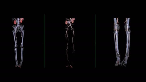 Кадры Cta Бедренной Артерии Изолированы Черном — стоковое видео