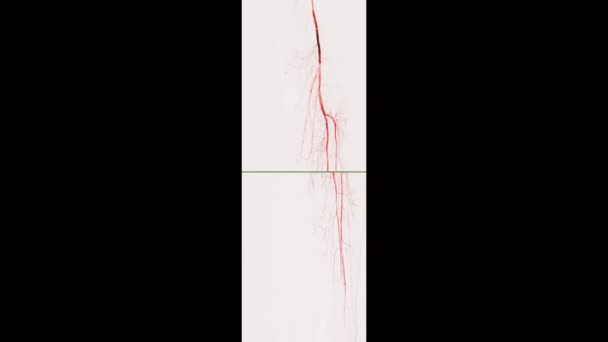 Aufnahmen Der Beinarterienangiographie Isoliert Auf Schwarz — Stockvideo