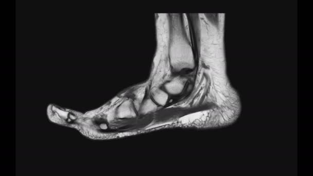 Footage Mri Foot Scan Isolated Black — Stockvideo