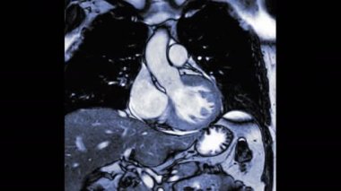 Kalp MR 'ı ya da kalp MR' ı, kalp atışının kalp rahatsızlığını tespit etmek için sol ventriküler çıkış yolunu gösteriyor..