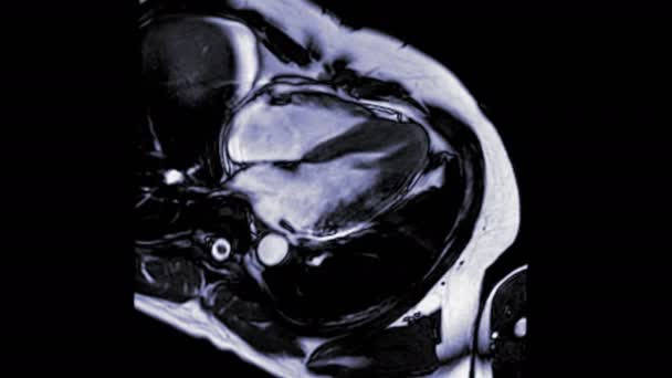 Mri Καρδιά Καρδιοαγγειακή Mri Μαγνητική Τομογραφία Της Καρδιάς Θέα Θάλαμο — Αρχείο Βίντεο