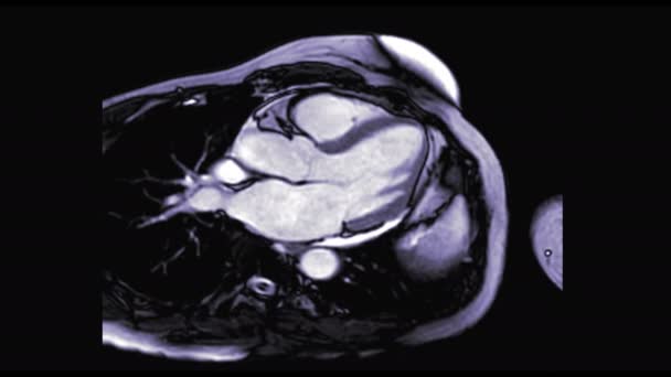 Mri Hjärta Eller Hjärt Mri Magnetisk Resonanstomografi Hjärtat Kammare Visa — Stockvideo