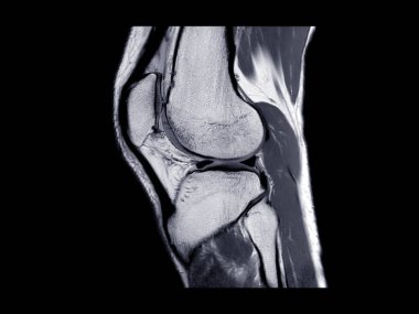 MR Diz eklem veya Manyetik rezonans görüntüleme sagittal görünümü ön çapraz bağ dokusunda yırtılma veya burkulma tespit etmek için (Acl).