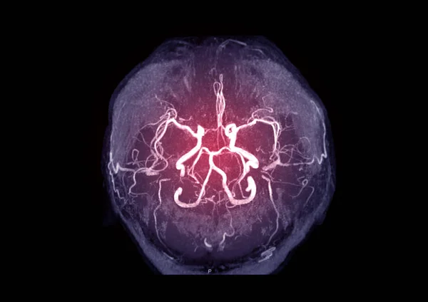 Mra Brain Magnetische Resonantie Angiografie Mra Van Cerebrale Slagader Hersenen — Stockfoto