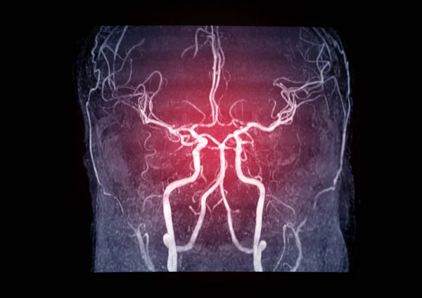 Мра Мозг Магнитно Резонансная Ангиография Мра Мозговой Артерии Головном Мозге — стоковое фото