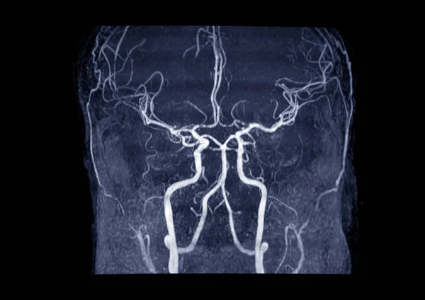 Mra Brain Magnetische Resonantie Angiografie Mra Van Cerebrale Slagader Hersenen — Stockfoto