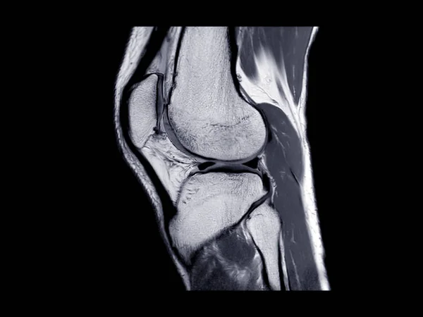 Rmn Articulación Rodilla Imagen Por Resonancia Magnética Vista Sagital Para — Foto de Stock