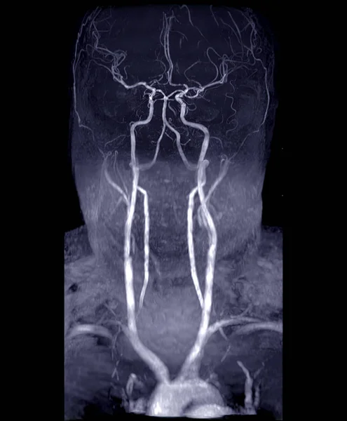 Mra Hjerne Hals Eller Magnetisk Resonans Angiografi Mra Cerebral Arterie - Stock-foto