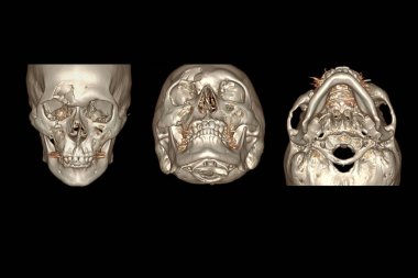 CT Facial Bone 3D rendering  image isolated on black background showing fracture frontal bone . clipart