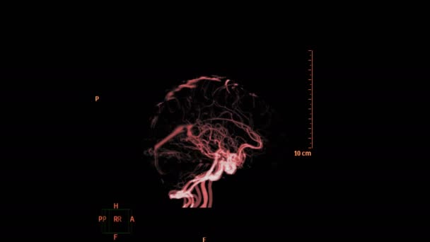 Beynin Cta Görüntüsü Siyah Üzerine Izole — Stok video