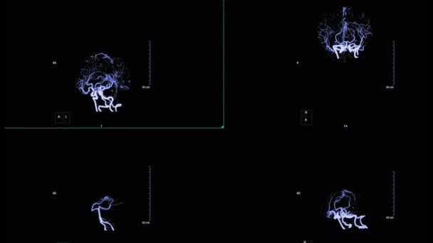 Séquences Cta Cerveau Isolé Sur Noir — Video