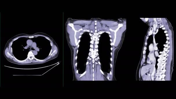 Radiografia Tórax Com Imagem Renderização Cta Aorta Inteira Dentro Tórax — Vídeo de Stock