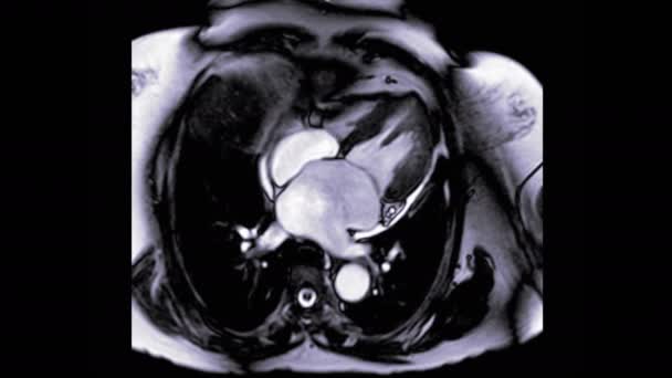 Mri Szív Vagy Szív Mri Mágneses Rezonancia Képalkotás Szív Kamra — Stock videók