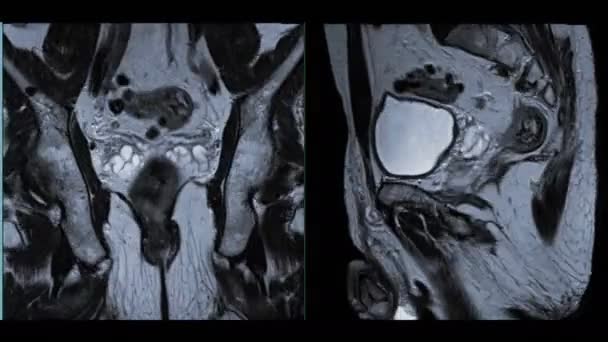 Prostata Röntgenbild Mit Rendering — Stockvideo