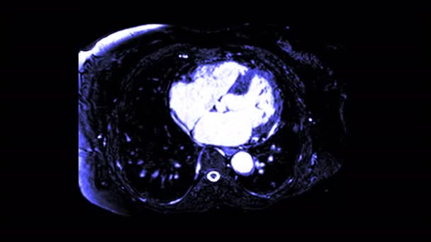 Ressonância Magnética Cardíaca Cardíaca Coração Câmaras Mostrando Átrio Esquerdo Ventrículo — Vídeo de Stock
