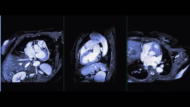 Mri心臓または心臓Mri心臓の磁気共鳴画像3左室ビューのアトリウム 心疾患を検出するための僧帽弁および大動脈弁 — ストック動画