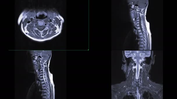 Radiografía Columna Vertebral Con Imagen Renderizado Cta — Vídeos de Stock