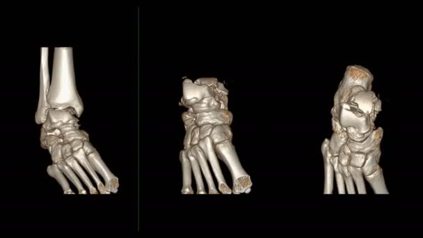 Tanı Tendonu Yaralanması Için Ayak Bileği Yay Görünümünü Karşılaştır — Stok video