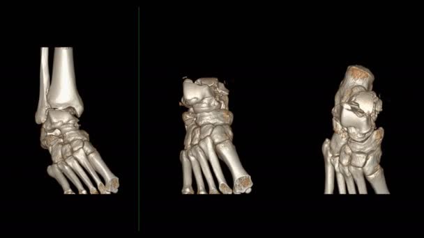 Compare Mri Ankle Sagittal View Diagnostic Tendon Injury — 비디오