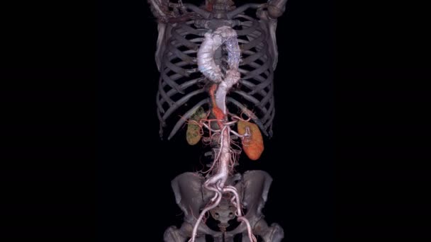 全主动脉3D图像在屏幕上回转以检测腹主动脉瘤或腹主动脉瘤 — 图库视频影像
