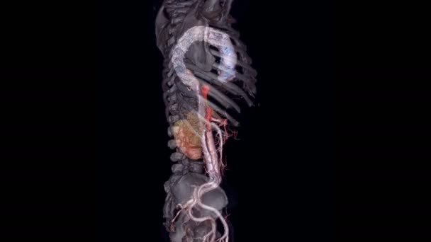 Cta全体大動脈3Dレンダリング画像は 腹部大動脈瘤やAaaを検出するための画面上で好転します — ストック動画