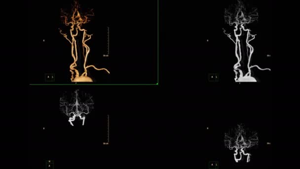 Πλάνα Από Cta Brain Απομονωμένο Μαύρο — Αρχείο Βίντεο