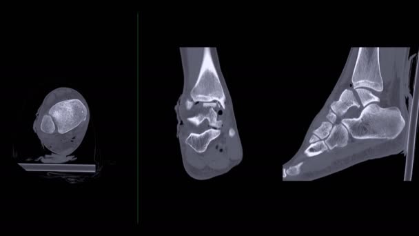 Confrontare Mri Caviglia Sagittal Vista Lesioni Tendini Diagnostici — Video Stock