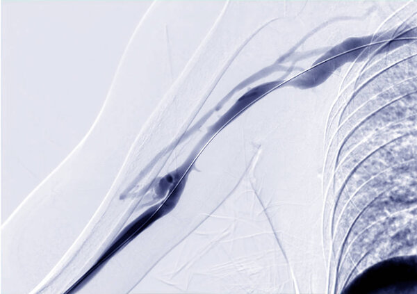 Angioplasty, balloon angioplasty and percutaneous transluminal angioplasty (PTA) on right arm.