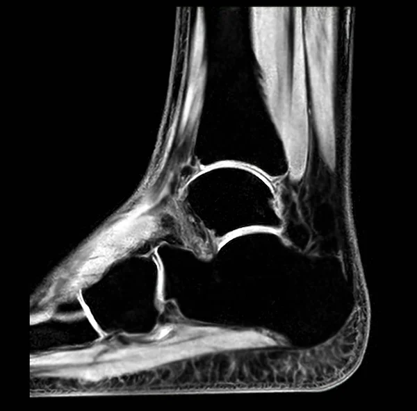 Mri Ankle Widok Strzałkowy Pokazujący Czarną Kość Diagnostycznego Urazu Ścięgna — Zdjęcie stockowe