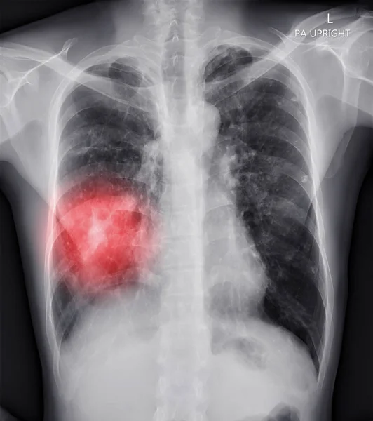 Chest Ray Ray Image Human Chest Showing Tuberculosi — Stock Photo, Image
