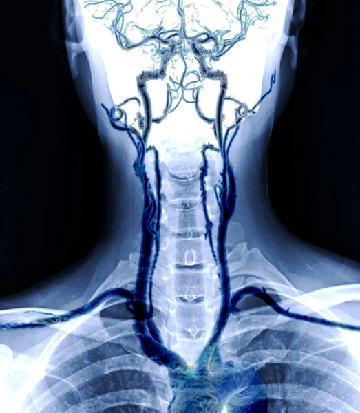 X-ray C-spine or x-ray image of Cervical spine AP  view with cta carotid artery .