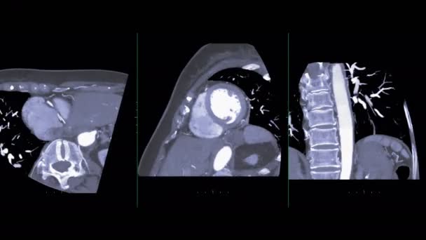 séquence de plaine cardiaque isolée sur noir 