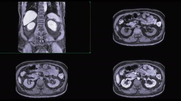 séquences de mri supérieur abd 4view isolé sur noir 