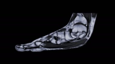 Ayak yaralanmasının teşhis tendonu için MR-Foot Sagittal T2w.