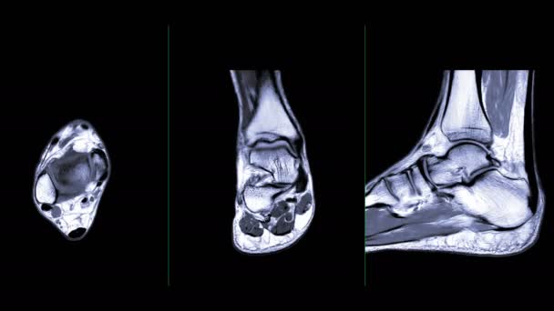 Comparer de mri articulation de la cheville axiale, coronale et sagittale T2 pour le diagnostic tendon de blessure articulaire de la cheville .