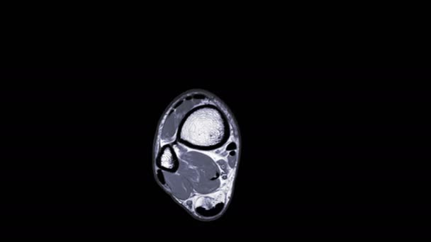 Mri Ankle Axial Pdw Sequence Diagnostic Tendon Ankle Injury — Stock Video