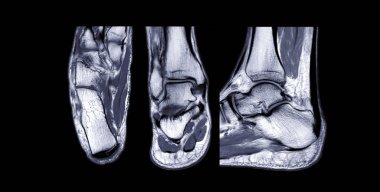 Tanısal tendon hasarı için MR Bileği eklem eksenini, koronal ve Sagittal t2 görünümünü karşılaştır.